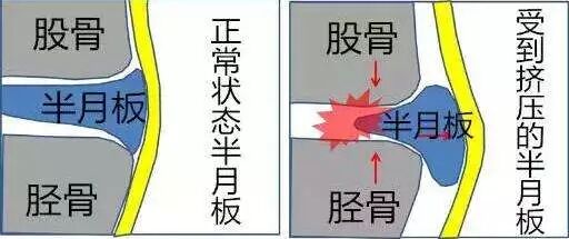 正常关节里有“水”吗？关节腔积液的症状？