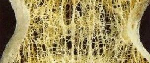 警惕！这九类人更易得骨质疏松！