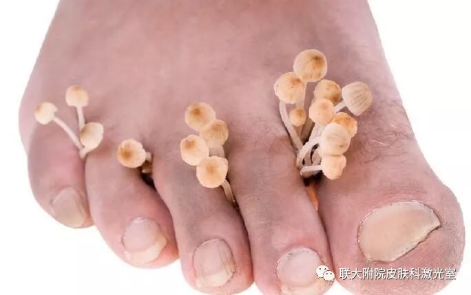 皮肤科医生和你聊聊癣 联大附院皮肤科激光室 微信公众号文章阅读 Wemp