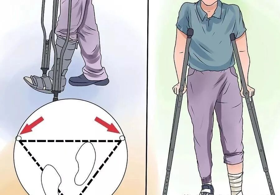 肘拐怎么用康复鲁西｜这堂课，教您正确用拐杖_https://www.jmylbn.com_新闻资讯_第11张