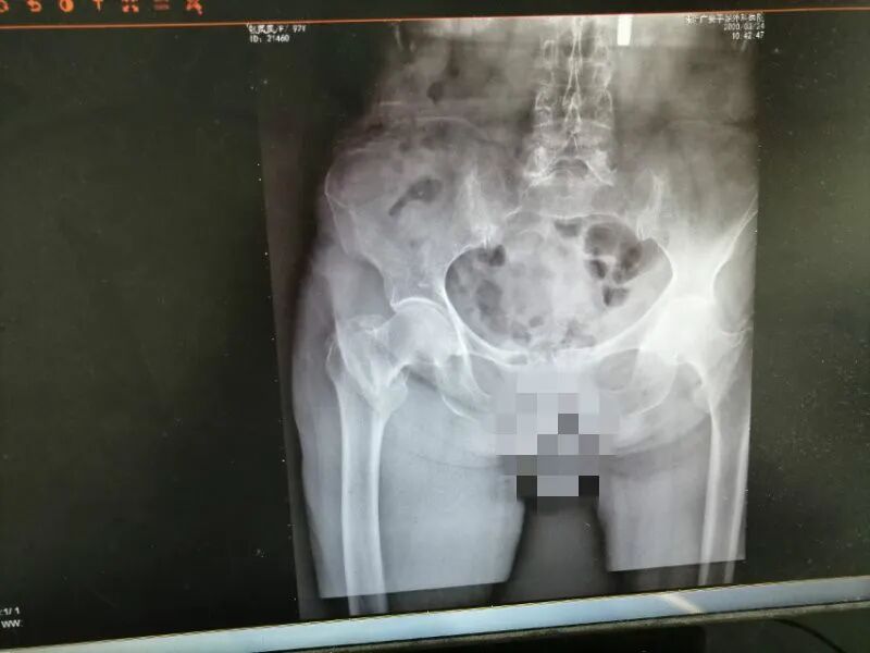 痛心，92岁老人髋部骨折，广安医院妙手回春