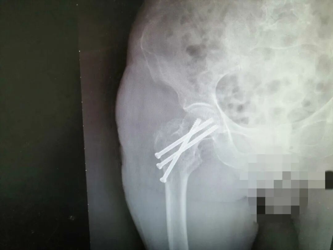 痛心，92岁老人髋部骨折，广安医院妙手回春