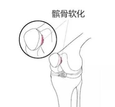 膝盖越动越痛是怎么回事？