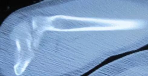 为什么骨折以前打个石膏，现在却要病人“遭罪”打钢板？