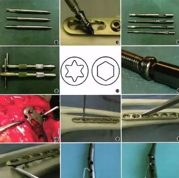 骨科内固定物取不取？什么时候取？怎么取？