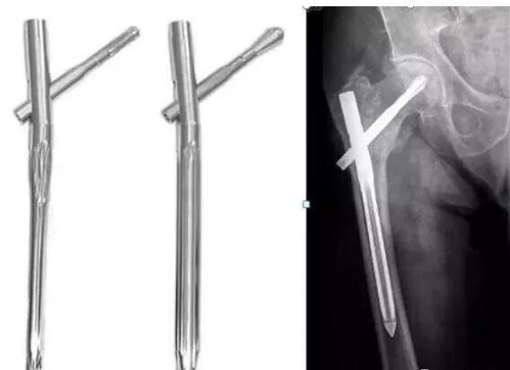 骨科内固定物取不取？什么时候取？怎么取？