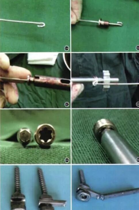 骨科内固定物取不取？什么时候取？怎么取？