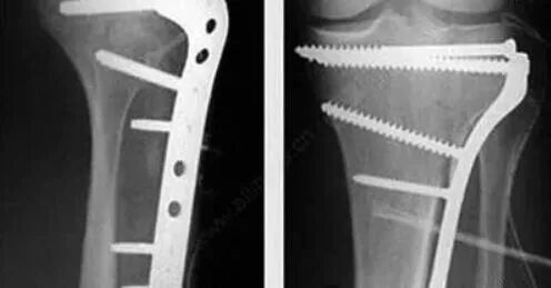 骨科内固定物取不取？什么时候取？怎么取？