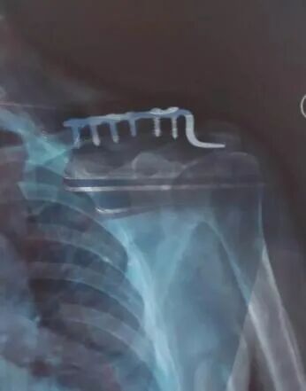 骨科内固定物取不取？什么时候取？怎么取？