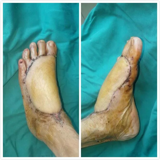 车祸受伤触目惊心 植皮手术妙手回春