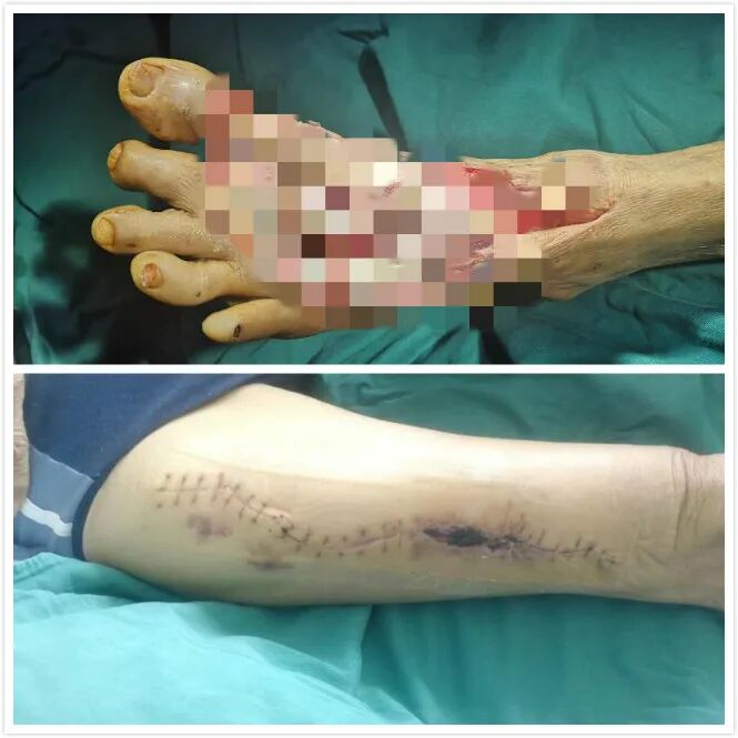 车祸受伤触目惊心 植皮手术妙手回春