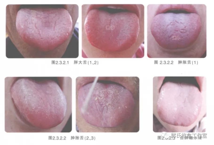舌诊分享——林氏中医群，续12（望舌形）