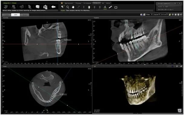 口腔ct怎么拍摄【科普】什么是牙科CT？牙科CT在种植牙中的运用_https://www.jmylbn.com_新闻资讯_第6张