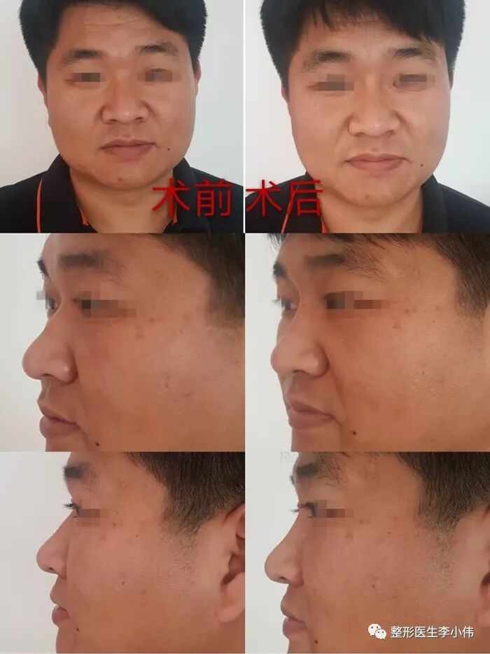 玻尿酸可以告别塌鼻梁 更有男人味 整形医生李小伟 微信公众号文章阅读 Wemp