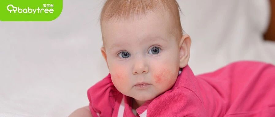 干货 | 几种宝宝常见皮肤问题的护理方法！速速收藏！