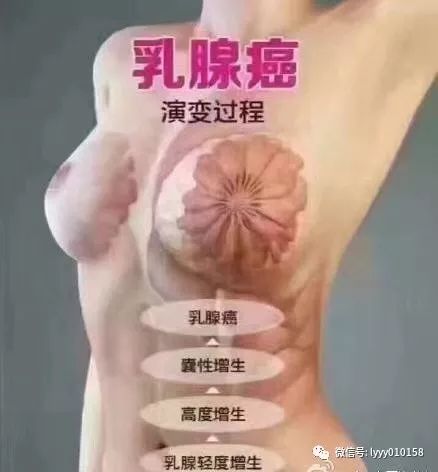 为什么易错过乳腺癌最佳治疗期 警惕乳腺癌入侵的五大早期信号 保您一生健康 微信公众号文章阅读 Wemp