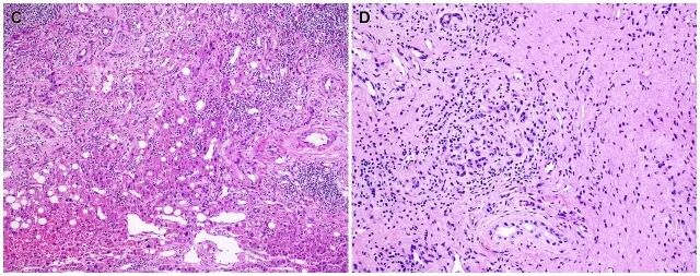 胆管细胞癌(二)-肝内胆管细胞癌