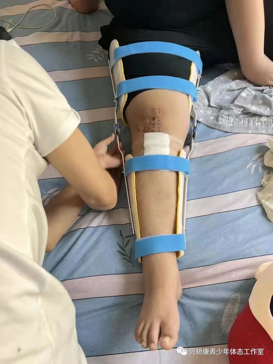 什么是外固定什么是术后骨折外固定康复支具？外固定支具是代替石膏固定最好的替代品！_https://www.jmylbn.com_新闻资讯_第5张