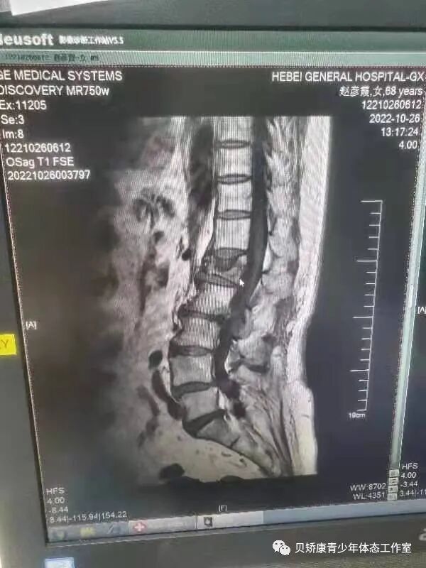 什么是外固定什么是术后骨折外固定康复支具？外固定支具是代替石膏固定最好的替代品！_https://www.jmylbn.com_新闻资讯_第2张