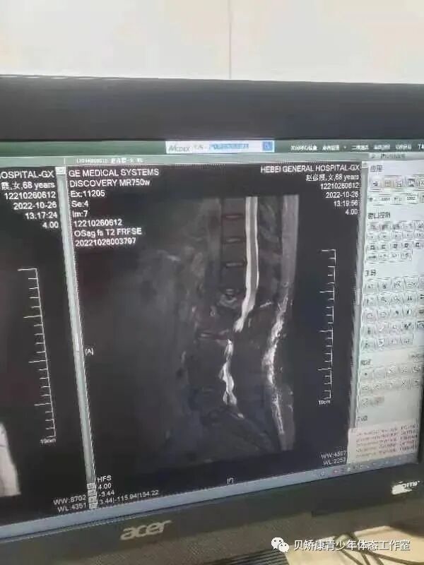 什么是外固定什么是术后骨折外固定康复支具？外固定支具是代替石膏固定最好的替代品！_https://www.jmylbn.com_新闻资讯_第1张