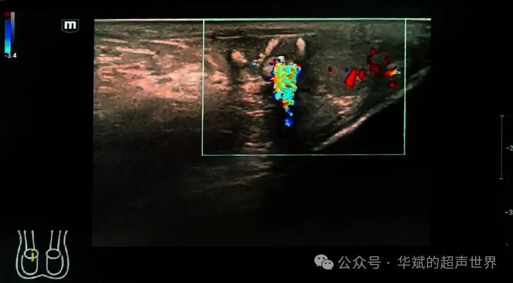 彩超伪像是什么超声问答•附睾头内的强回声斑快闪伪像考虑什么？_https://www.jmylbn.com_新闻资讯_第3张