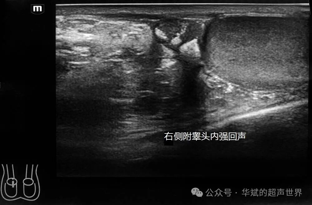 彩超伪像是什么超声问答•附睾头内的强回声斑快闪伪像考虑什么？_https://www.jmylbn.com_新闻资讯_第2张