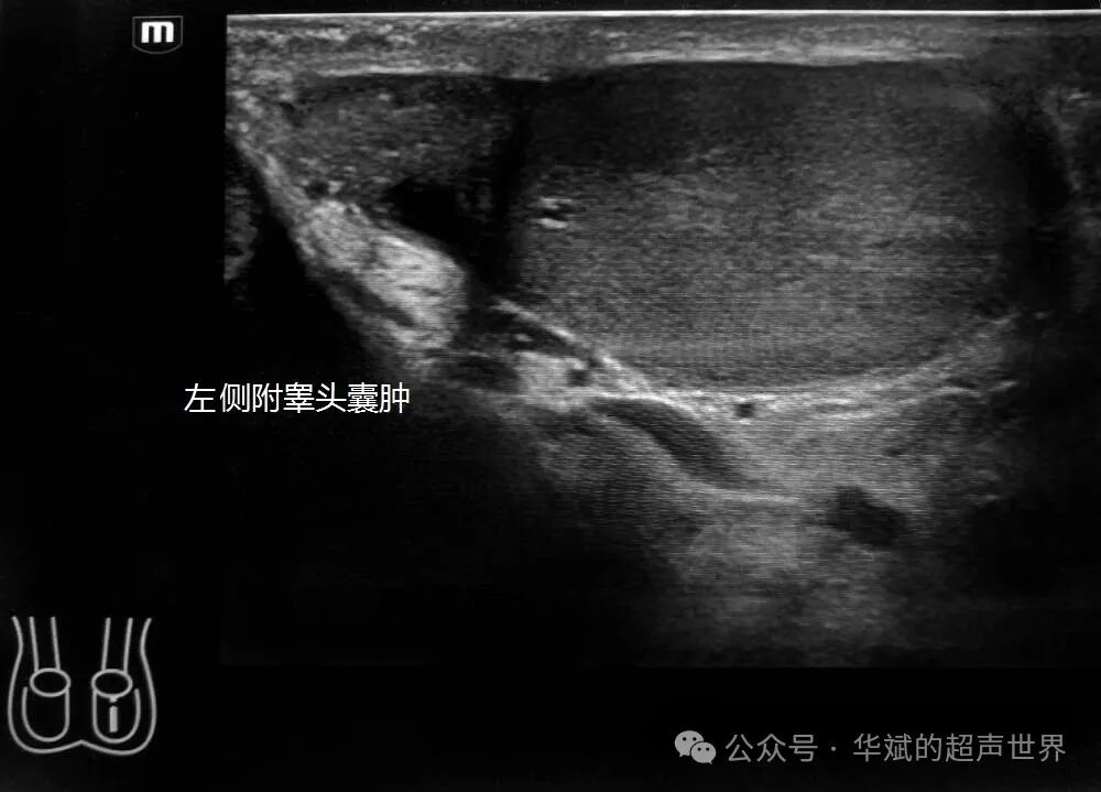 彩超伪像是什么超声问答•附睾头内的强回声斑快闪伪像考虑什么？_https://www.jmylbn.com_新闻资讯_第1张