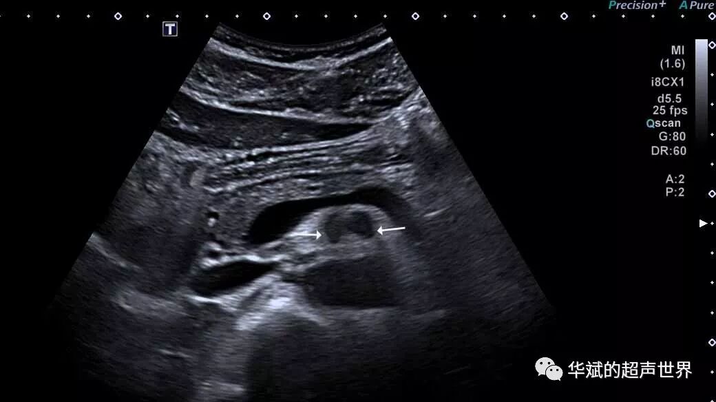 彩超伪像是什么超声伪像：折射伪像_https://www.jmylbn.com_新闻资讯_第2张