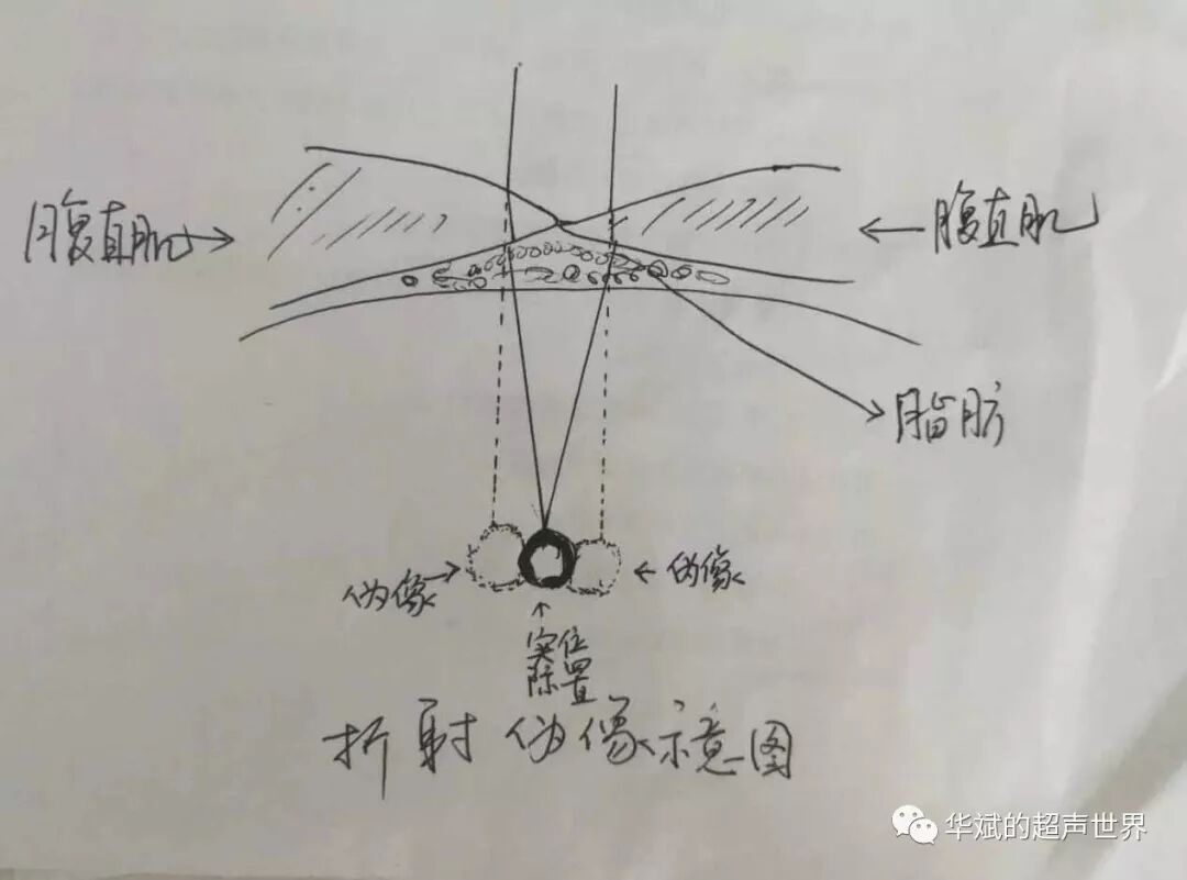 彩超伪像是什么超声伪像：折射伪像_https://www.jmylbn.com_新闻资讯_第1张