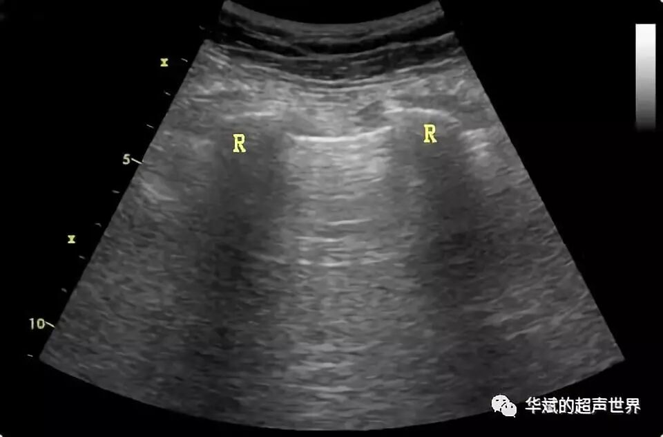彩超伪像是什么超声伪像：折射伪像_https://www.jmylbn.com_新闻资讯_第3张