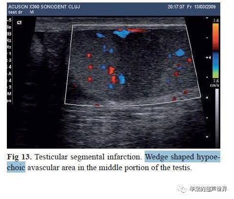 节段性睾丸梗塞 令人尴尬的 楔形 华斌的超声世界 二十次幂