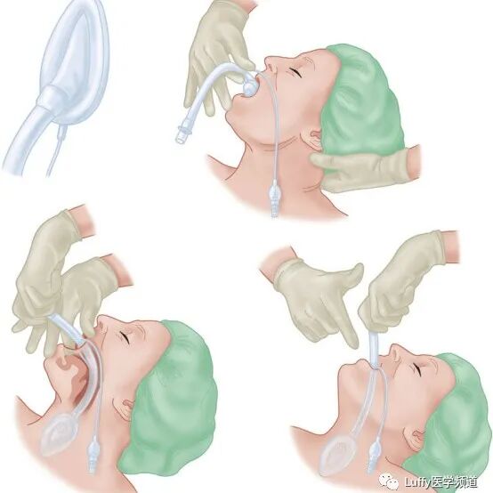 气管插管纱布怎么垫急诊仅0.4%？梅奥专家揭秘：清醒插管85%成功率的救命法则！(附详细图解)_https://www.jmylbn.com_新闻资讯_第21张