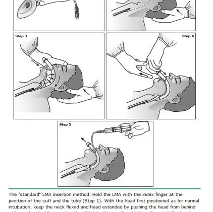 气管插管纱布怎么垫急诊仅0.4%？梅奥专家揭秘：清醒插管85%成功率的救命法则！(附详细图解)_https://www.jmylbn.com_新闻资讯_第30张