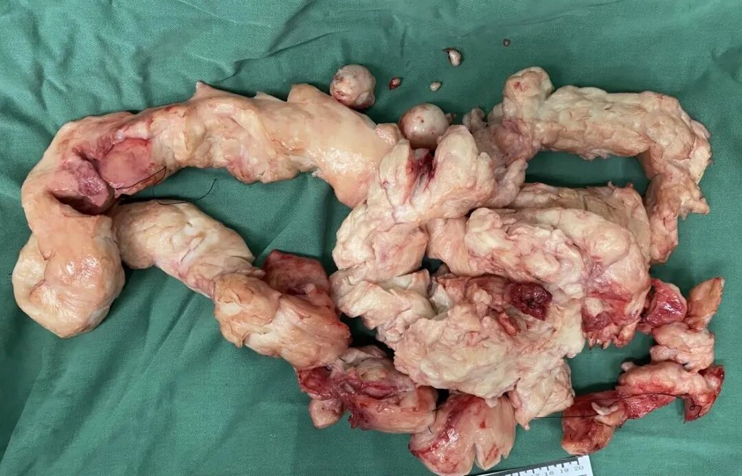 妇科器械盘怎么消毒妇科手术也“医美”_https://www.jmylbn.com_新闻资讯_第24张