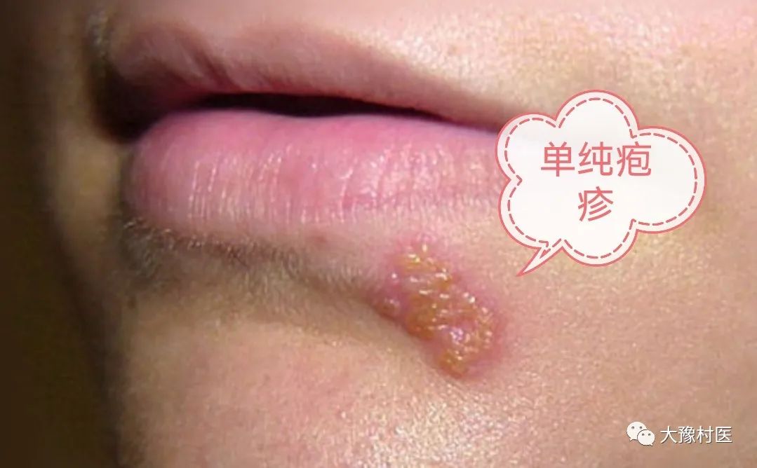 带状疱疹的中西医治疗