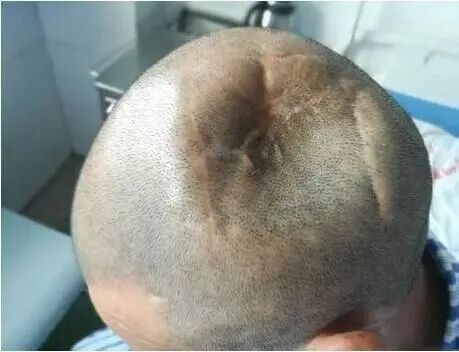 验伤报告三条提到的颅骨凹陷性骨折或粉碎性骨折则多发生于额,眼,顶骨