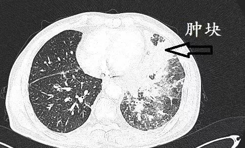 弥漫性肺癌图片