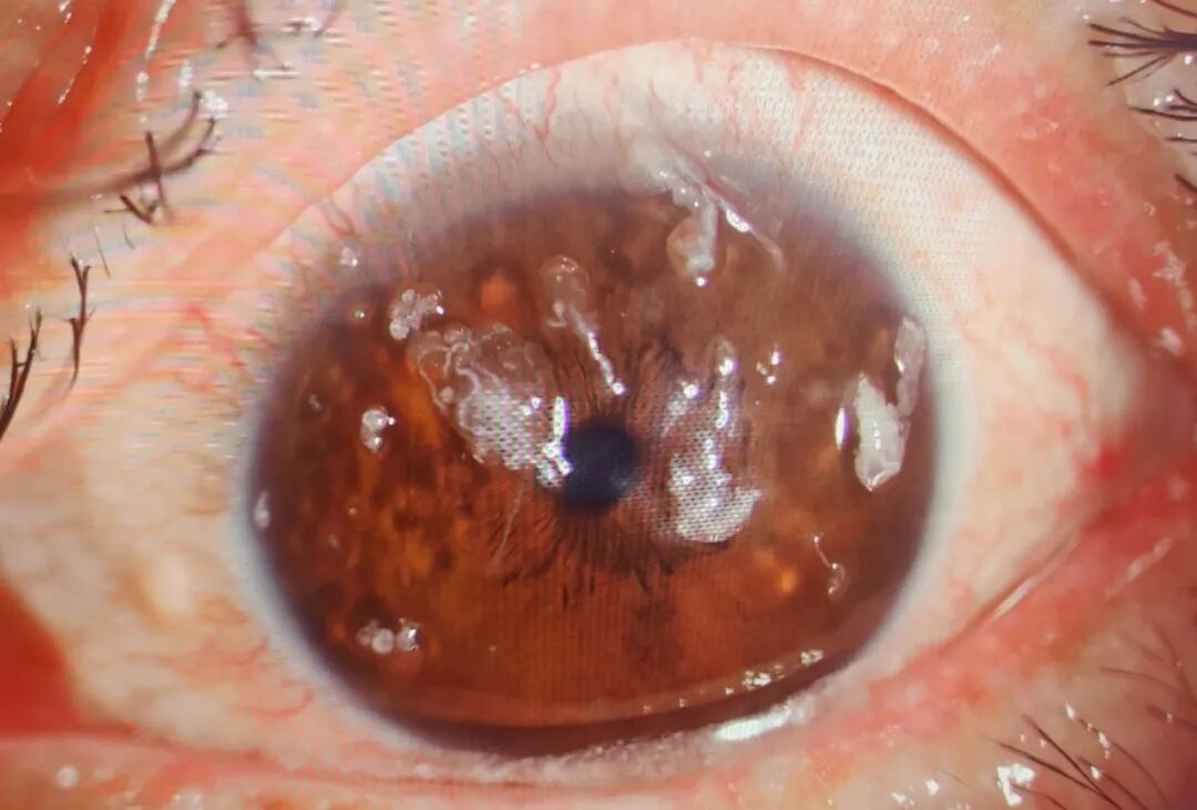 胡大夫的眼科门诊——眼睛长出白线是怎么回事?