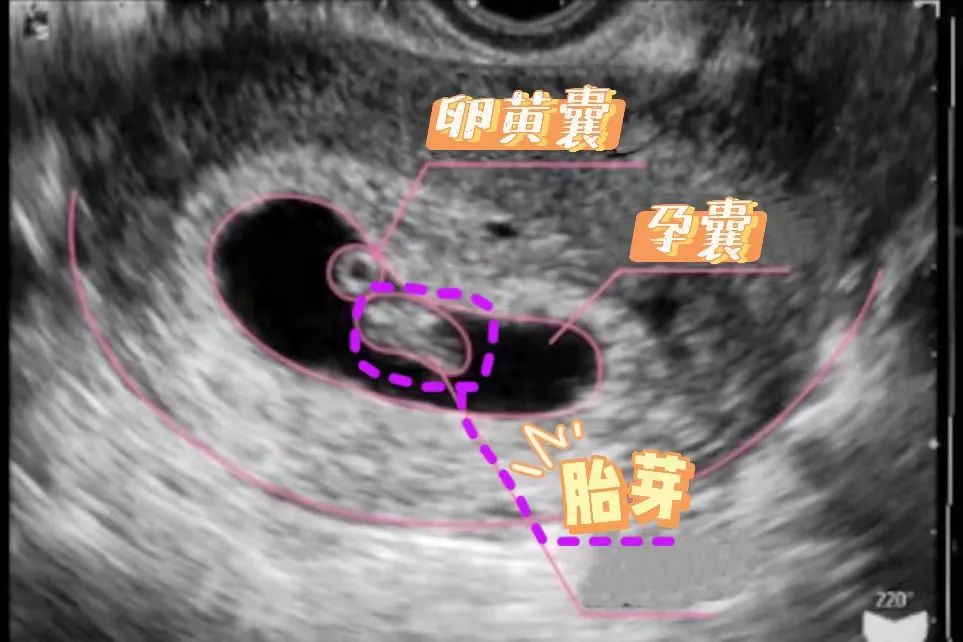 怀孕6周有胎心胎芽是不是就基本稳定了