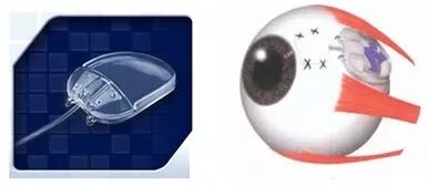 怎么装青光眼【科普时间】避免眼球摘除，他们在眼睛里装了一个阀门_https://www.jmylbn.com_新闻资讯_第2张