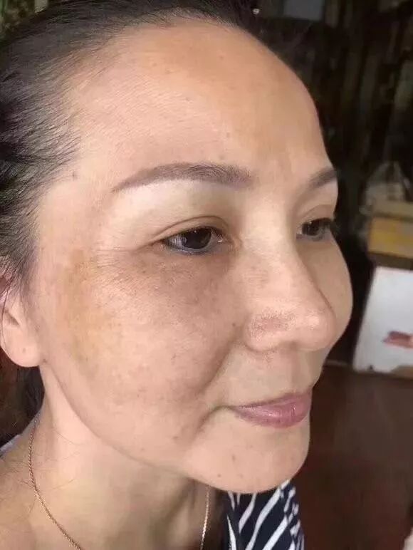 达人分享-祛斑专题