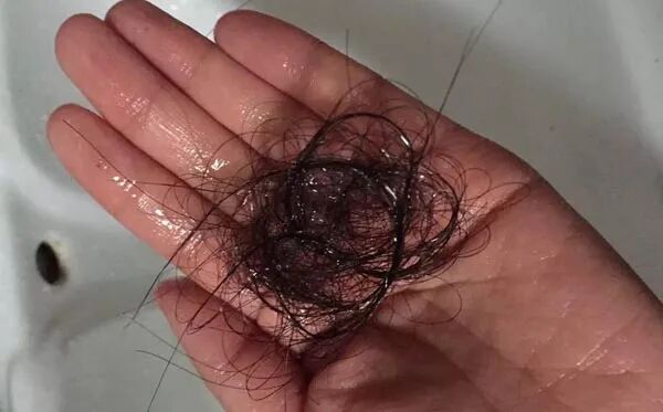 脱发吃什么药生发？这些方法，最快最有效！