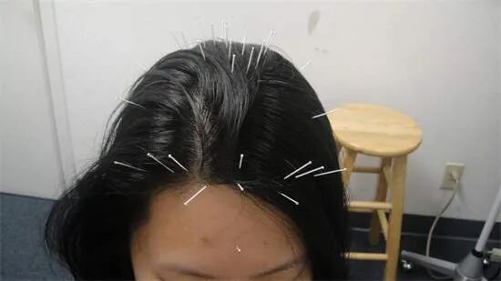 女性脱发怎么治疗四个方法防脱又生发