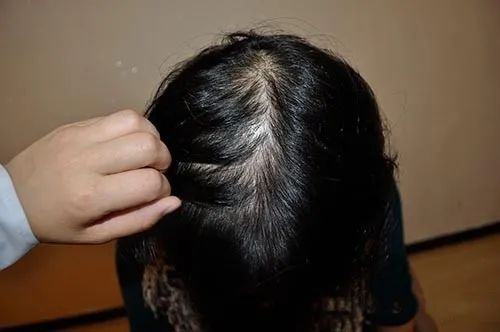 治疗女性脱发偏方（四个方法防脱又生发）