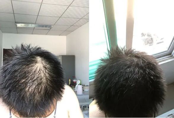 脱发吃什么药管用三种药物防脱又生发