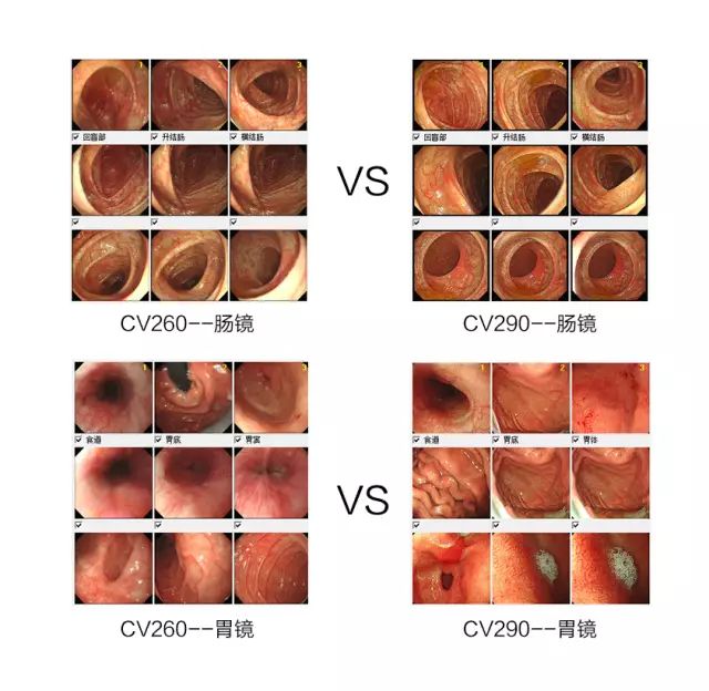 健康科普 | 大肠息肉来者不善，可能变成癌？