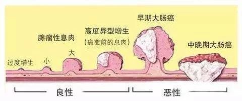 健康科普 | 大肠息肉来者不善，可能变成癌？