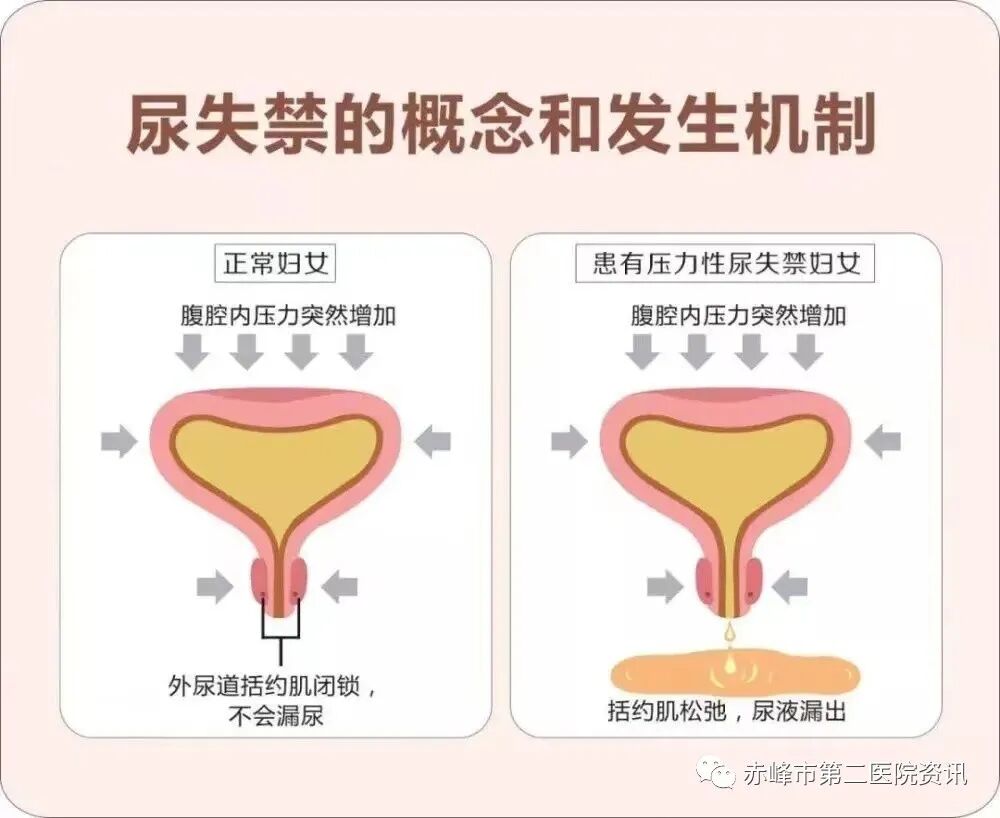 尿道张力过强怎么办赤峰市第二医院妇产科“经耻骨后无张力尿道中段悬吊术”30分钟轻松为您解决“尿失禁”的尴尬_https://www.jmylbn.com_新闻资讯_第6张