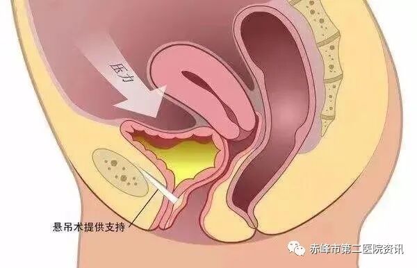 尿道张力过强怎么办赤峰市第二医院妇产科“经耻骨后无张力尿道中段悬吊术”30分钟轻松为您解决“尿失禁”的尴尬_https://www.jmylbn.com_新闻资讯_第8张