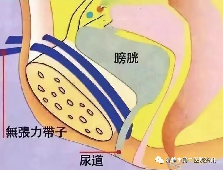 尿道张力过强怎么办赤峰市第二医院妇产科“经耻骨后无张力尿道中段悬吊术”30分钟轻松为您解决“尿失禁”的尴尬_https://www.jmylbn.com_新闻资讯_第10张